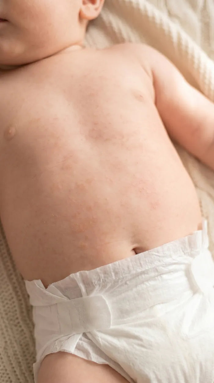 Illustration of dry, irritated baby skin before filtered baths